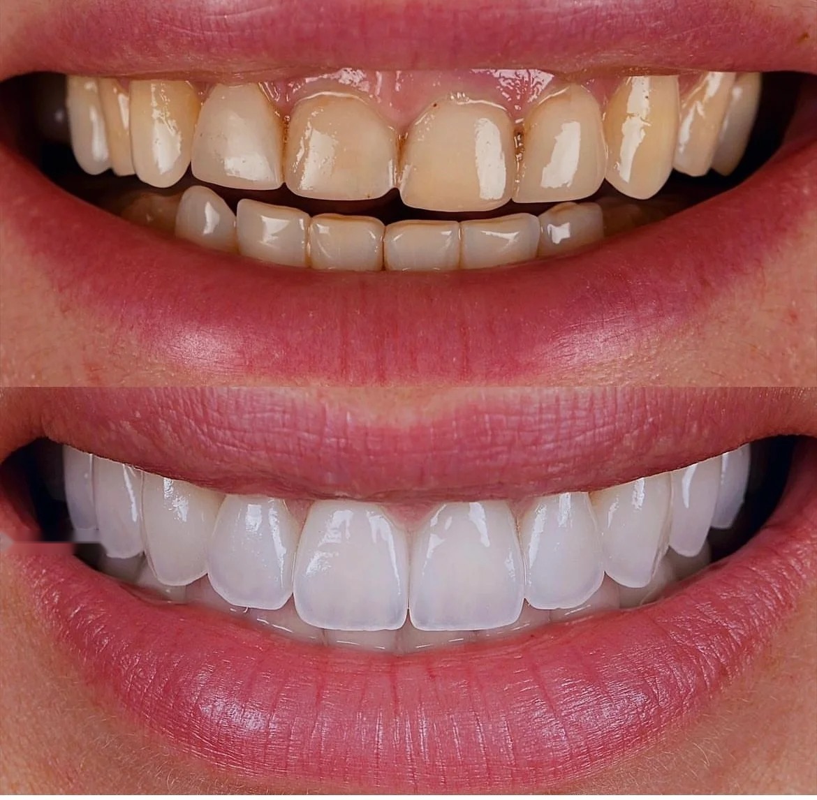 After treatment: complete master-crafted smile makeover, before: discolored enamel
